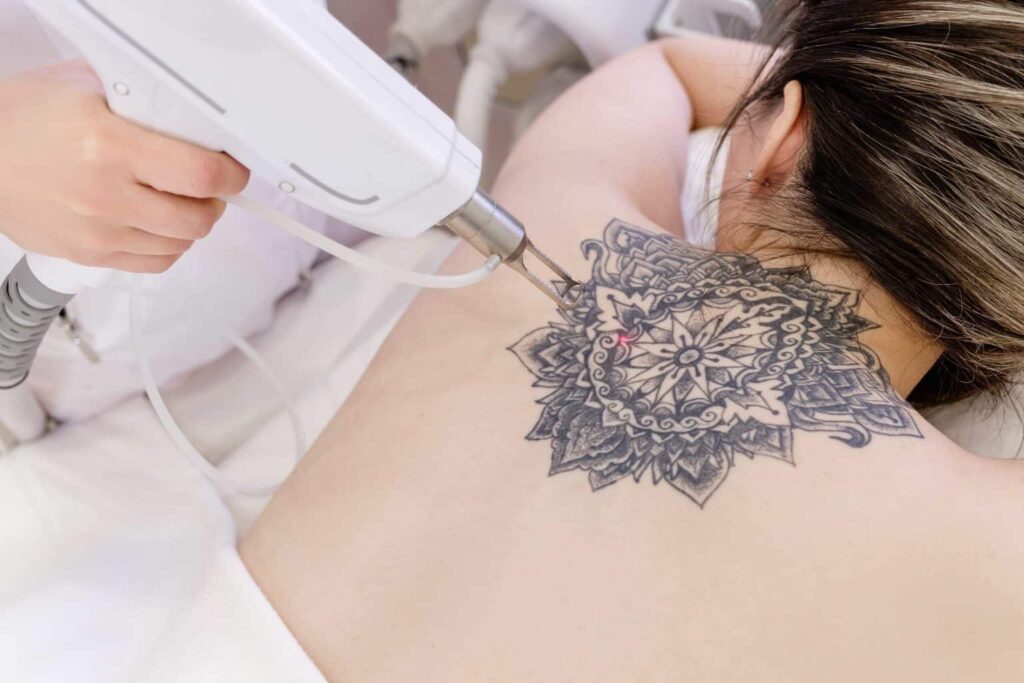 Laser Tattoo Removal The Art of Skin Restoration