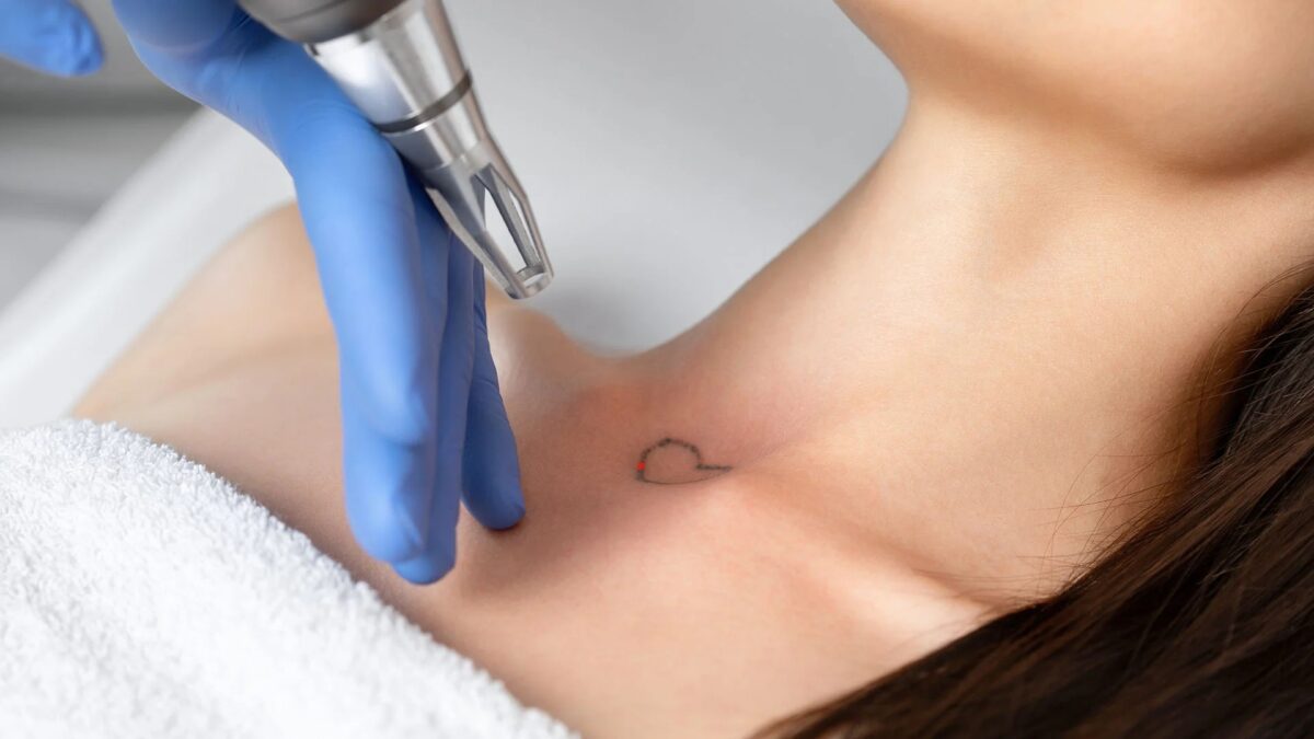 Laser Tattoo Removal The Art of Skin Restoration