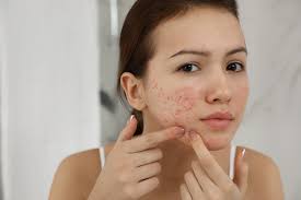 Maintaining Clear Skin Through Pimples Treatment Long-Term Strategies