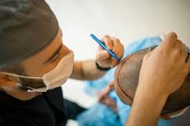 Hair Transplant Cost in Riyadh