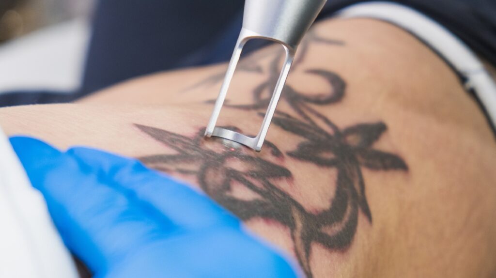 Debunking Common Myths About Laser Tattoo Removal