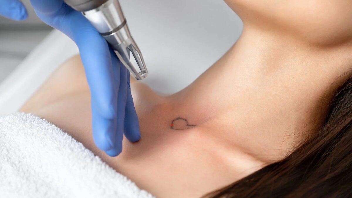 Debunking Common Myths About Laser Tattoo Removal