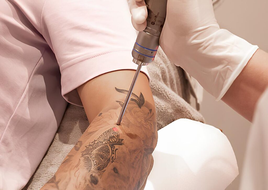 Say Goodbye to Ink with Laser Tattoo Removal