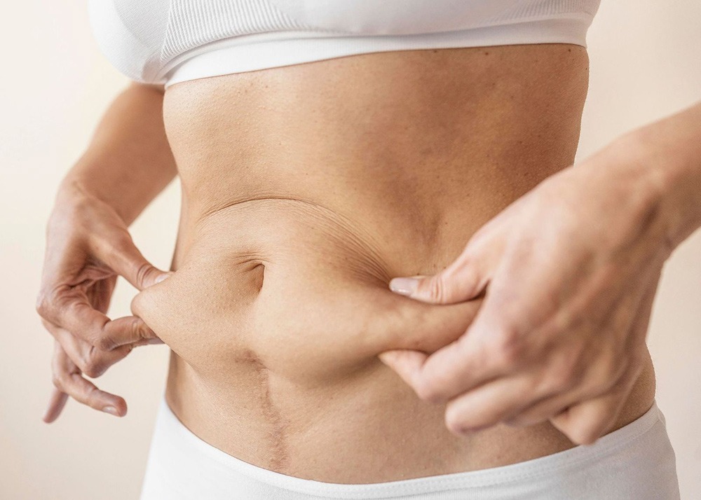 Lipo Abdominoplasty and Weight Loss: Understanding the Connection