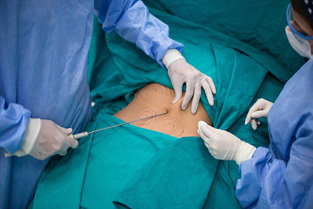 Liposuction: A Closer Look at the Recovery Process