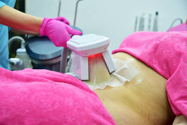 Long-Lasting Fat Loss with CoolSculpting