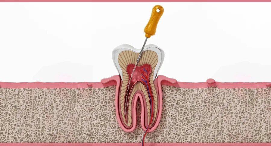 root canal services