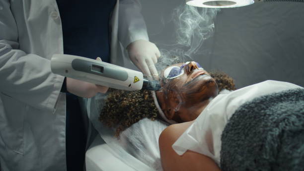 The Best Laser Carbon Peel Treatments for Skin Renewal