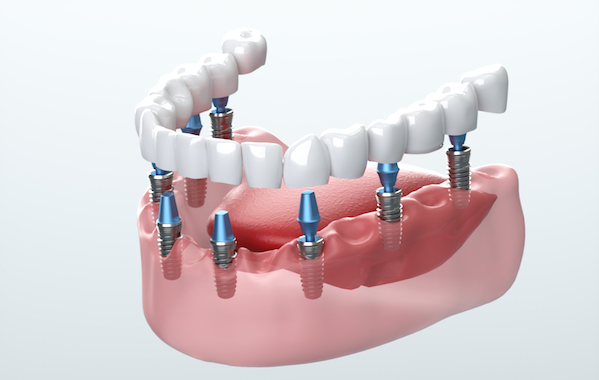 teeth implants in Portland OR