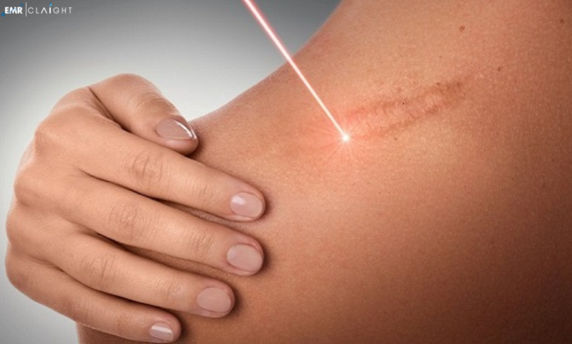 Global Scar Treatment Market | Share | Size | Growth | Trends | Outlook | Forecast | 2024 -2032