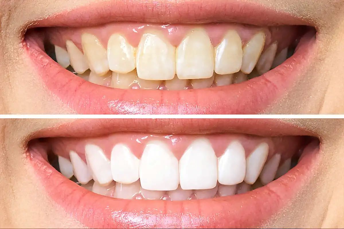 Shine Brighter with Our Superior Teeth Whitening Service in Boise ID