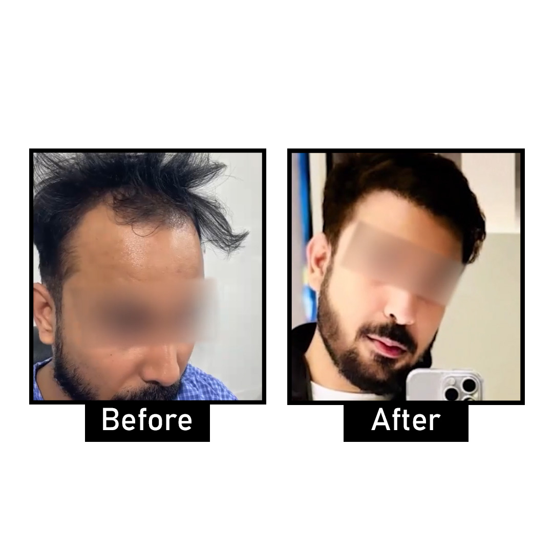 Best Hair Loss Treatment in Delhi: Restore Your Hair and Confidence