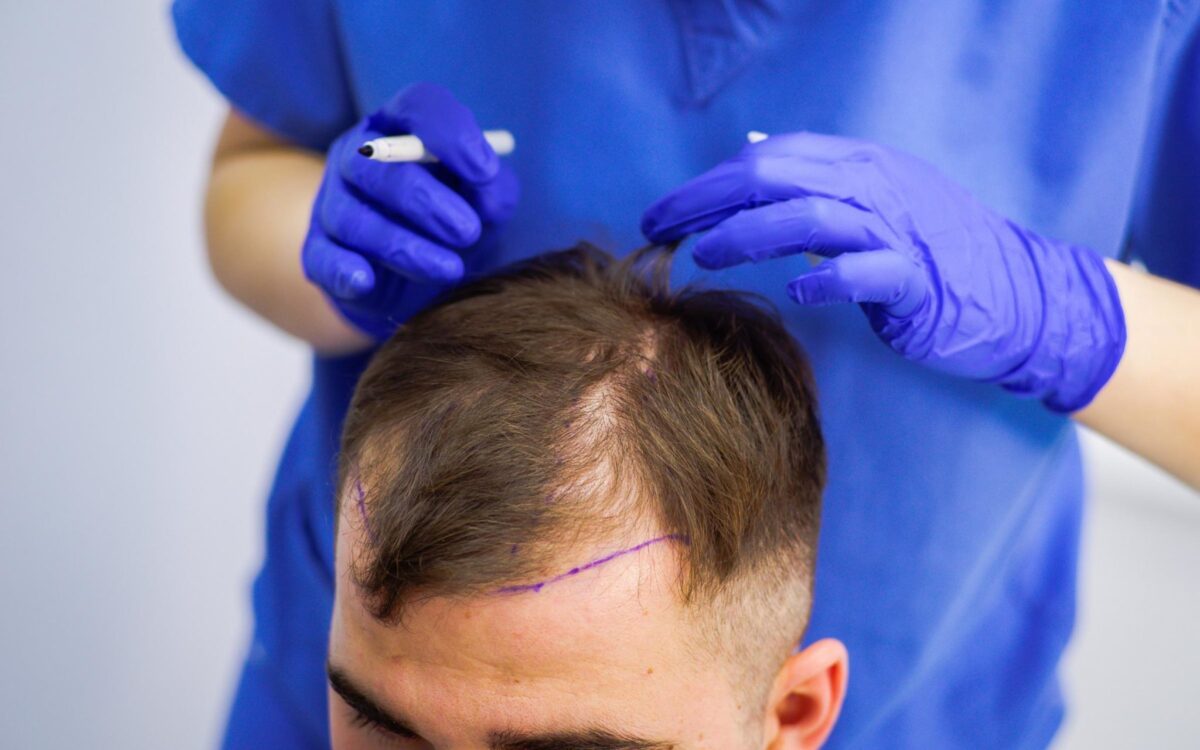 The Ultimate Guide to Hair Transplant Recovery in Buraydah