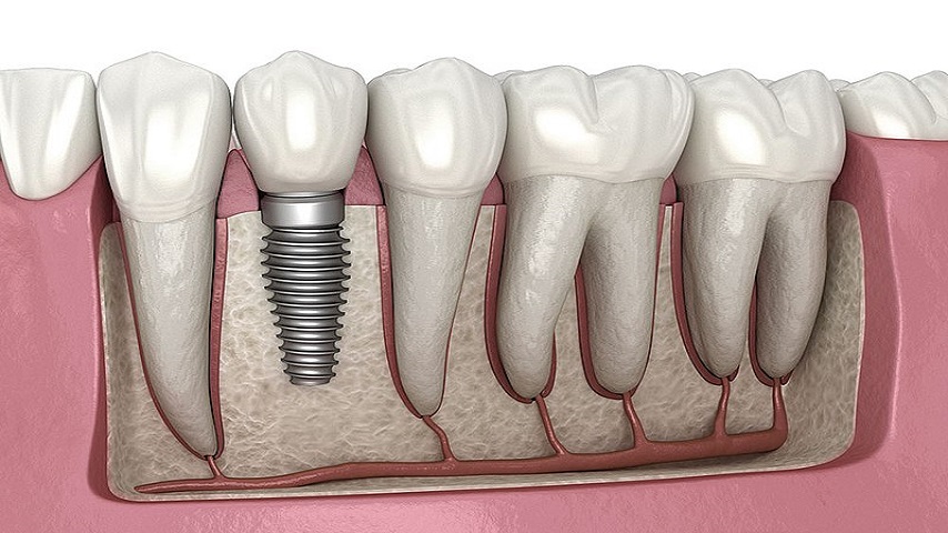 dental implants in London