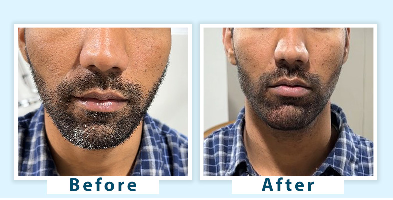 grey beard treatment, using natural remedies and professional solutions to restore beard color and maintain a youthful appearance