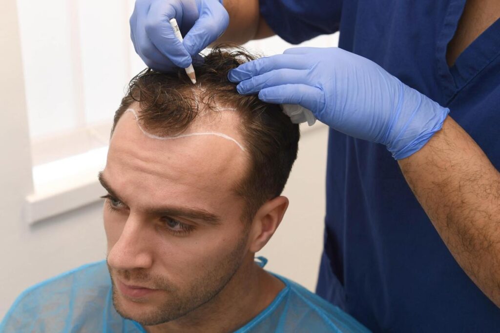 تكلفة زراعة الشعر