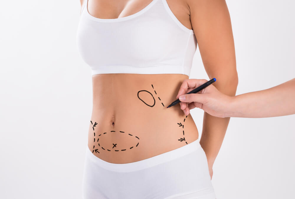 Liposuction Surgery in Dubai: Cost Breakdown and Factors