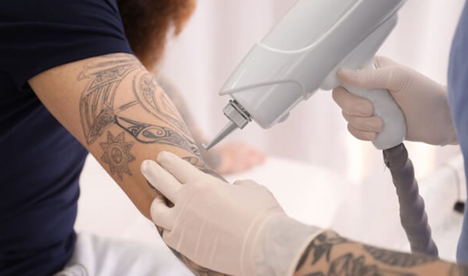 Laser Tattoo Removal Fresh Skin Starts Here