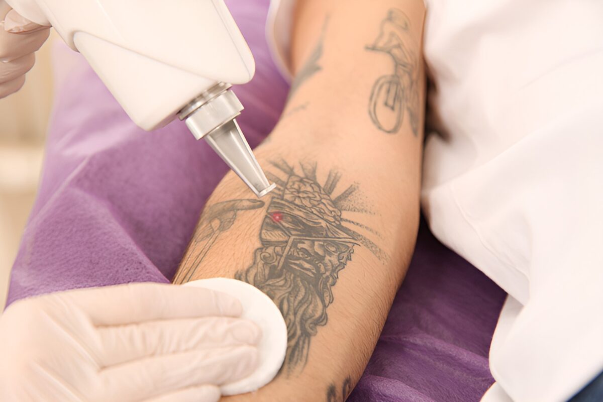 The Hidden Benefits of Laser Tattoo Removal Sessions