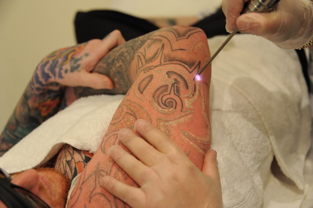 The Hidden Benefits of Laser Tattoo Removal Sessions