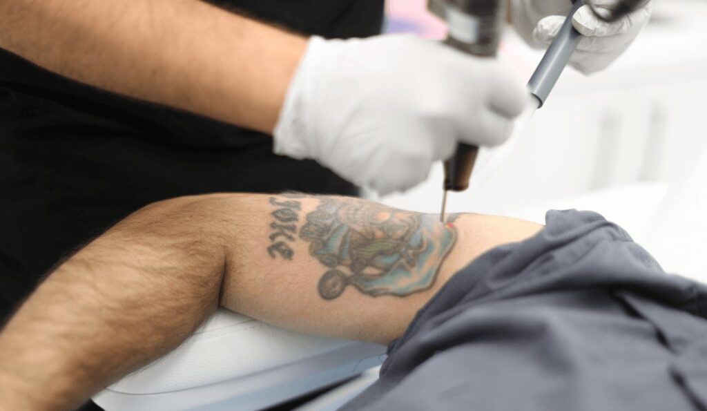 The Hidden Benefits of Laser Tattoo Removal Sessions