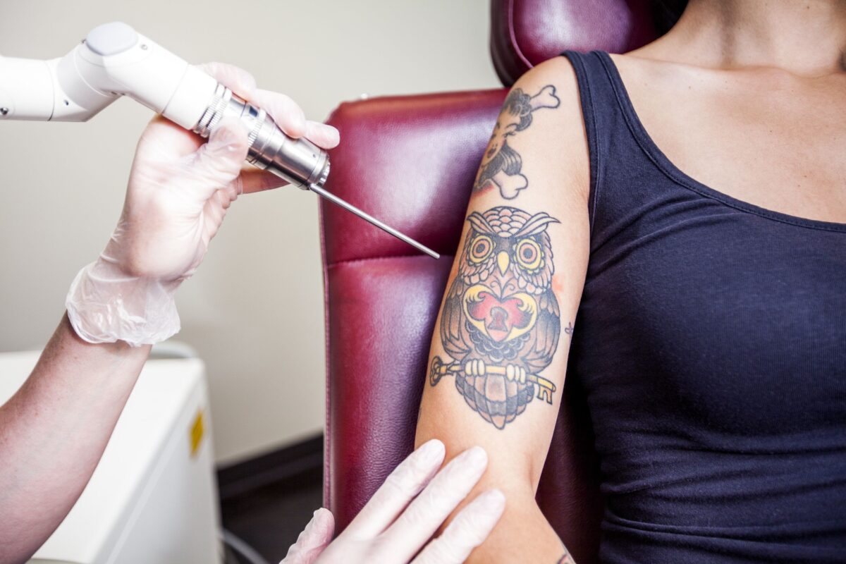 The Hidden Benefits of Laser Tattoo Removal Sessions