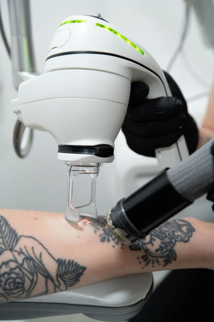 The Art of Letting Go: Moving On with Laser Tattoo Removal