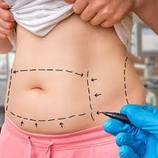 Liposuction in Dubai: Achieve Your Ultimate Body Goals