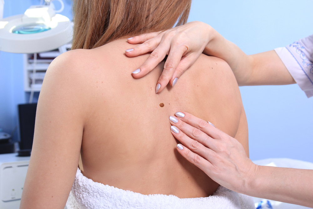 Mole Removal for Back: A Smooth and Clear Appearance