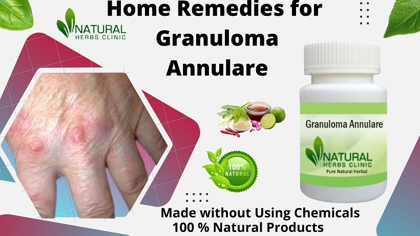 Herbal Supplements for Granuloma Annulare