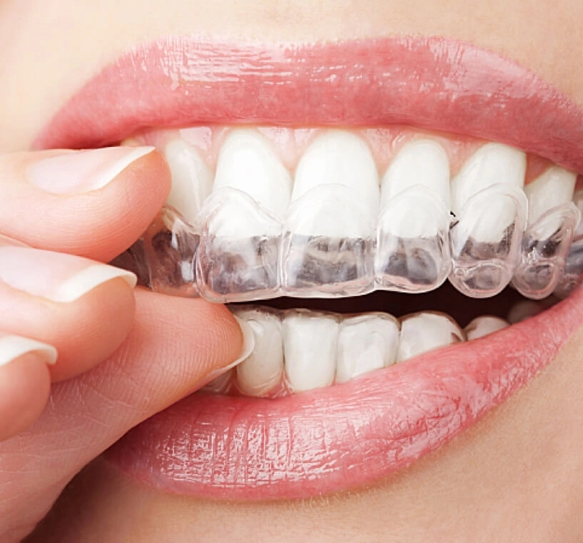 How Long Do You Need to Wear Retainers After Braces