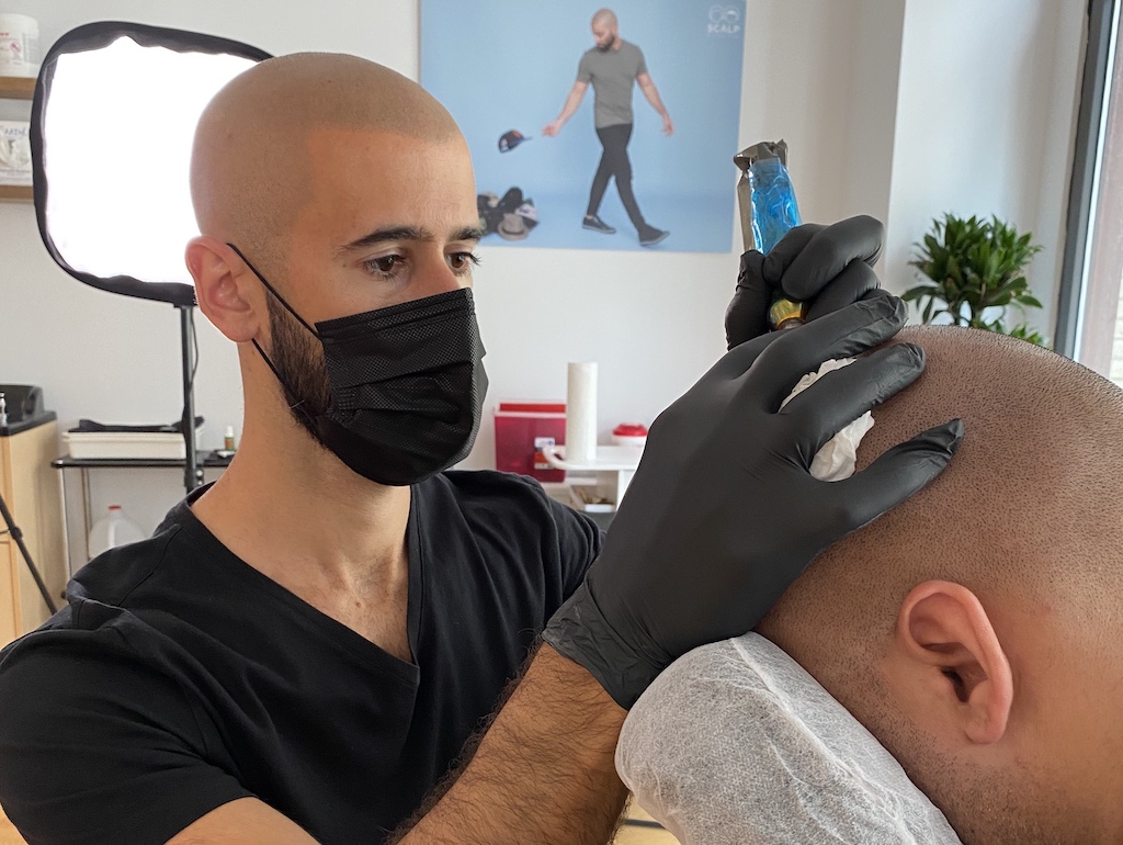 Look Younger with Scalp Micropigmentation Today