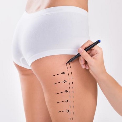 High Definition Liposculpture: The Future of Body Sculpting