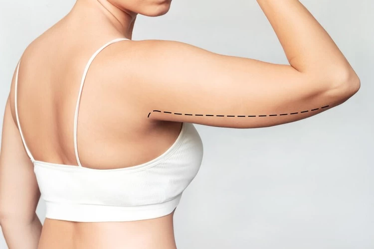 Overcoming Body Image Issues with Underarm Liposuction