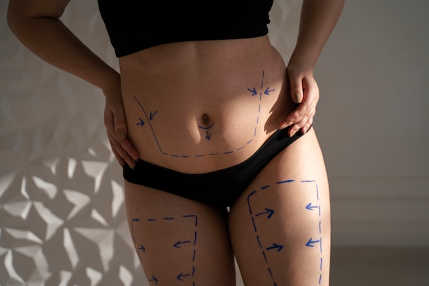 What is the Cost of Liposuction?