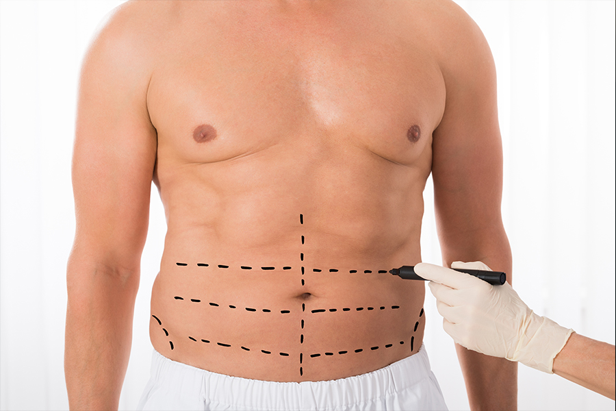 Liposuction Surgery for a Slimmer Waistline: Riyadh’s Solutions