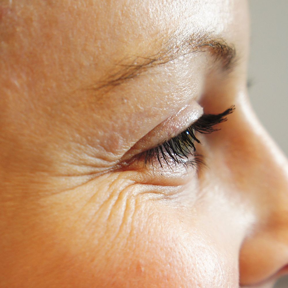 How to Treat Fine Lines and Wrinkles Without Surgery in Riyadh