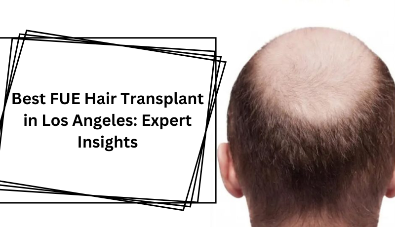 Best FUE Hair Transplant in Los Angeles: Expert Insights