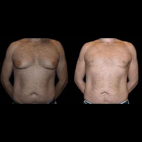 Success Rates of the Best Gynecomastia Surgeon in Dubai: What to Know