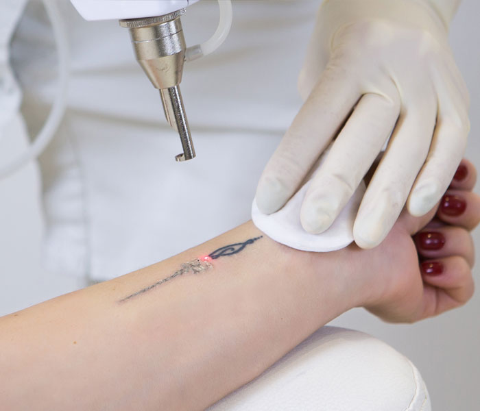 What Are the Different Types of Laser Technologies for Tattoo Removal?