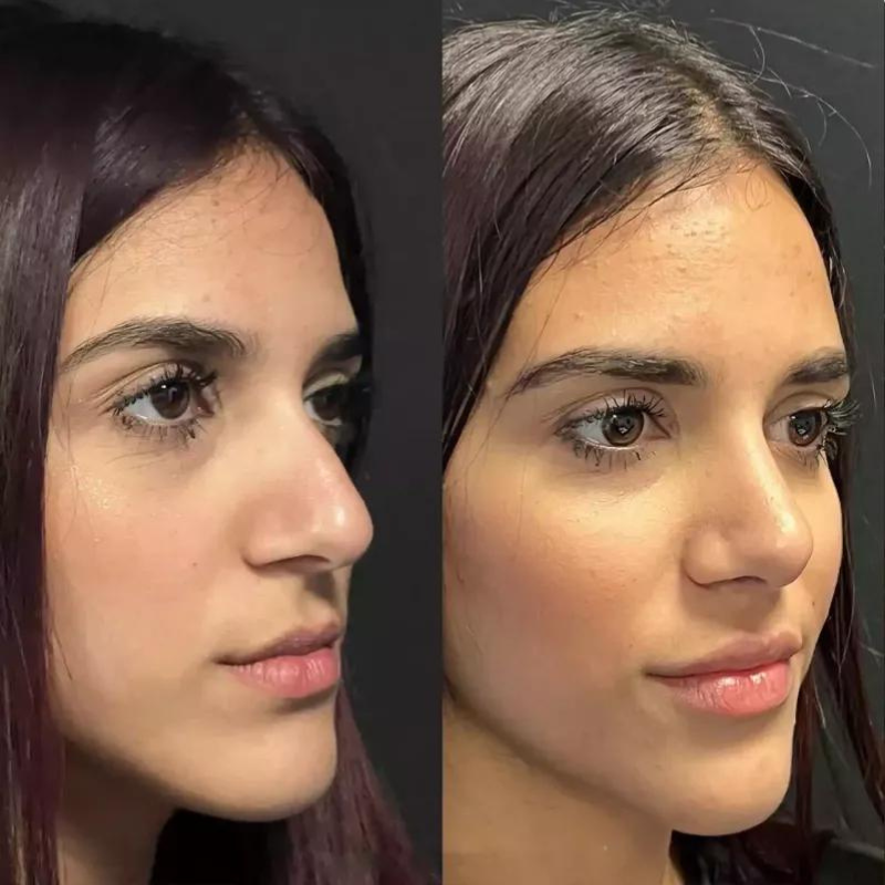 Evaluating the Best Rhinoplasty Surgeon in Dubai: Key Criteria