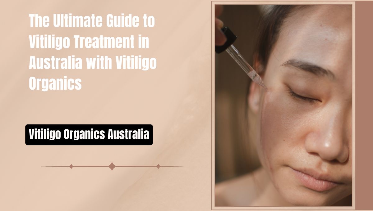 The Ultimate Guide to Vitiligo Treatment in Australia with Vitiligo Organics