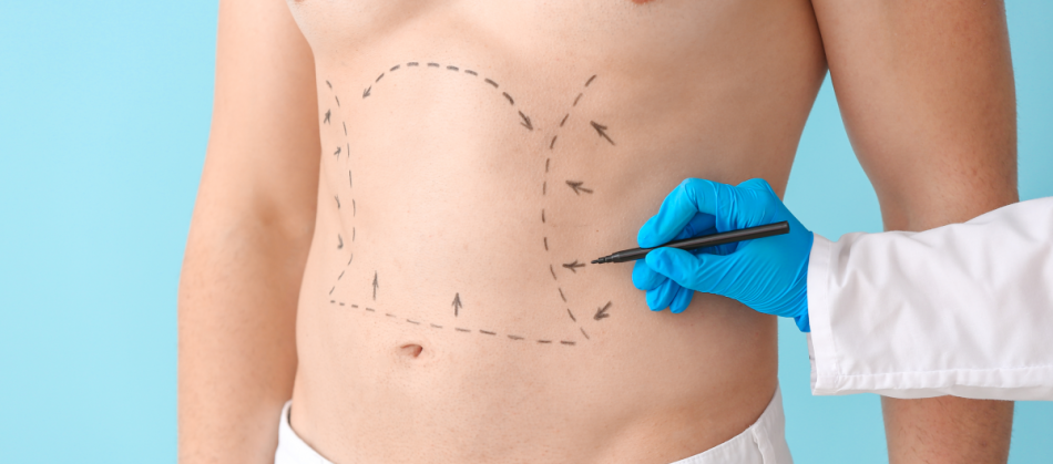 Safety and Success Rates of Liposuction in Riyadh