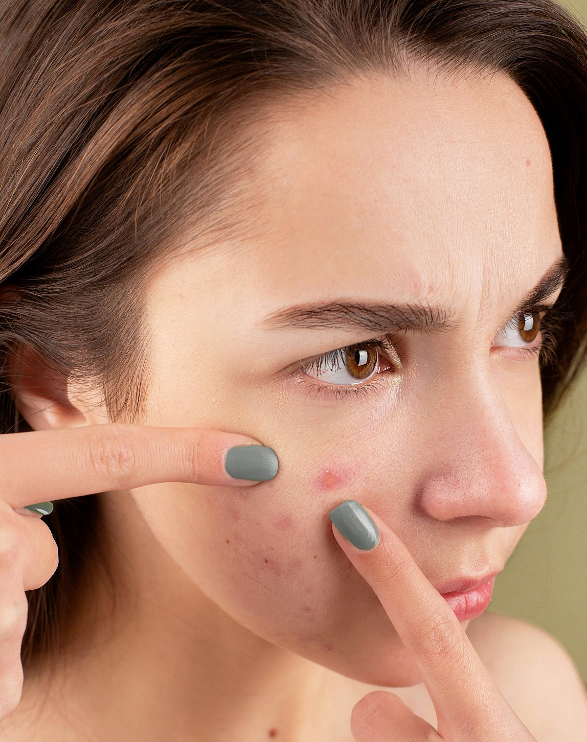 Smooth Skin Awaits: Acne Scar Treatments in Islamabad