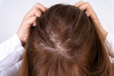 Alopecia Areata Treatment in Dubai