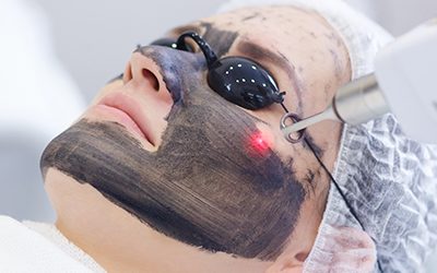 Are There Any Side Effects of Spectra Laser Carbon Peel? 