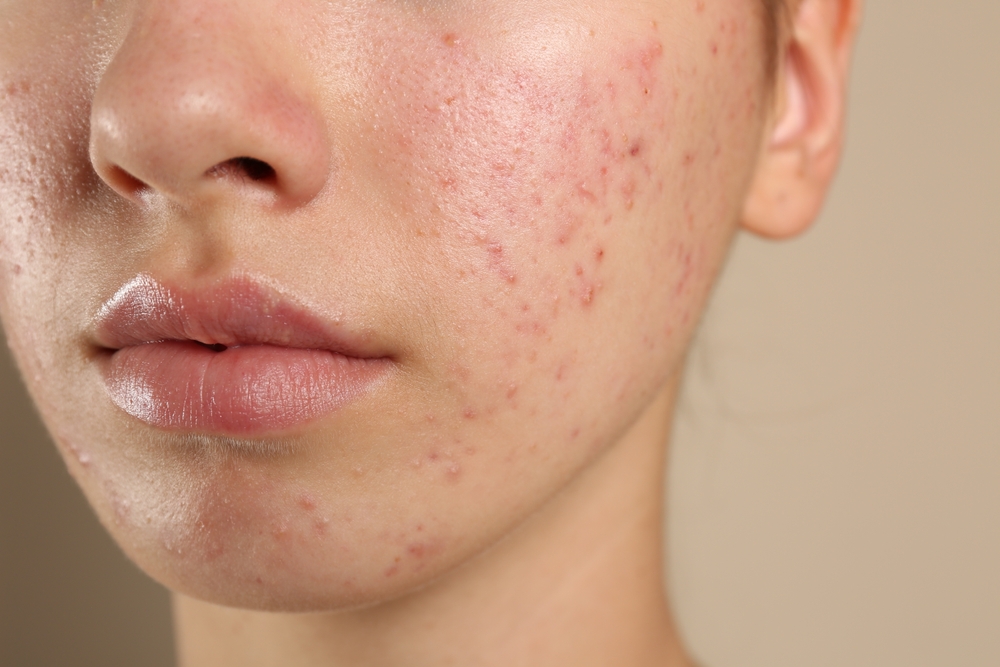 Banish Acne for Good Dermatologist-Approved Solutions