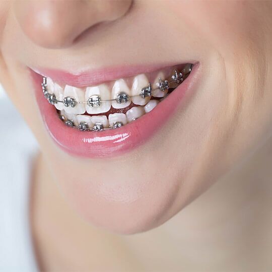 Dental Braces Cost In Dubai