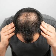 Hair Transplant in Dubai