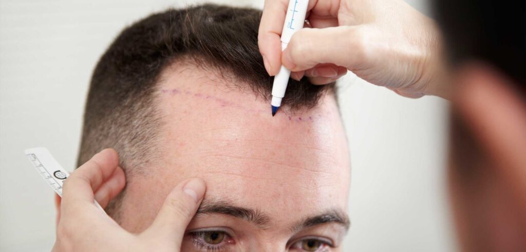 تكلفة زراعة الشعر في دبي